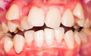 L'apparecchio ai denti è davvero inutile? Sfatiamo il mito