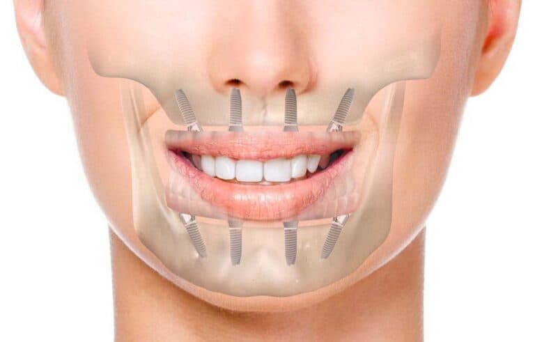 Come si mastica dopo un impianto dentale? Cosa aspettarsi