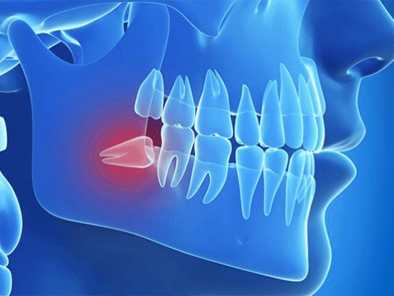 Il dente del giudizio sposta gli altri denti? Verità e falsi miti