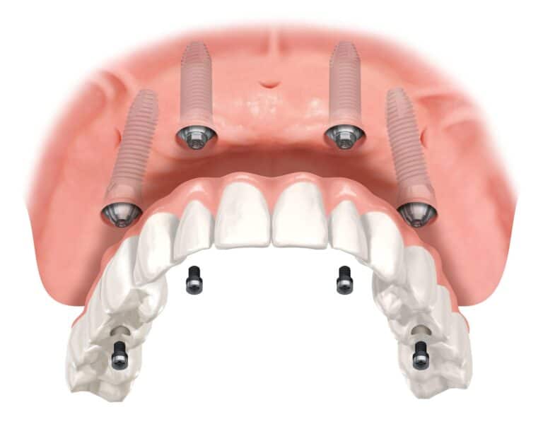 Denti fissi su 4 impianti in poche ore: come funziona