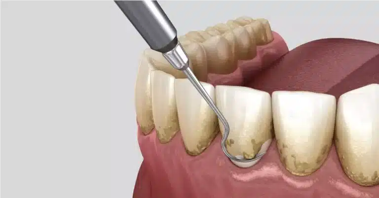 L'igiene dentale rovina i denti? Falsi miti da sfatare
