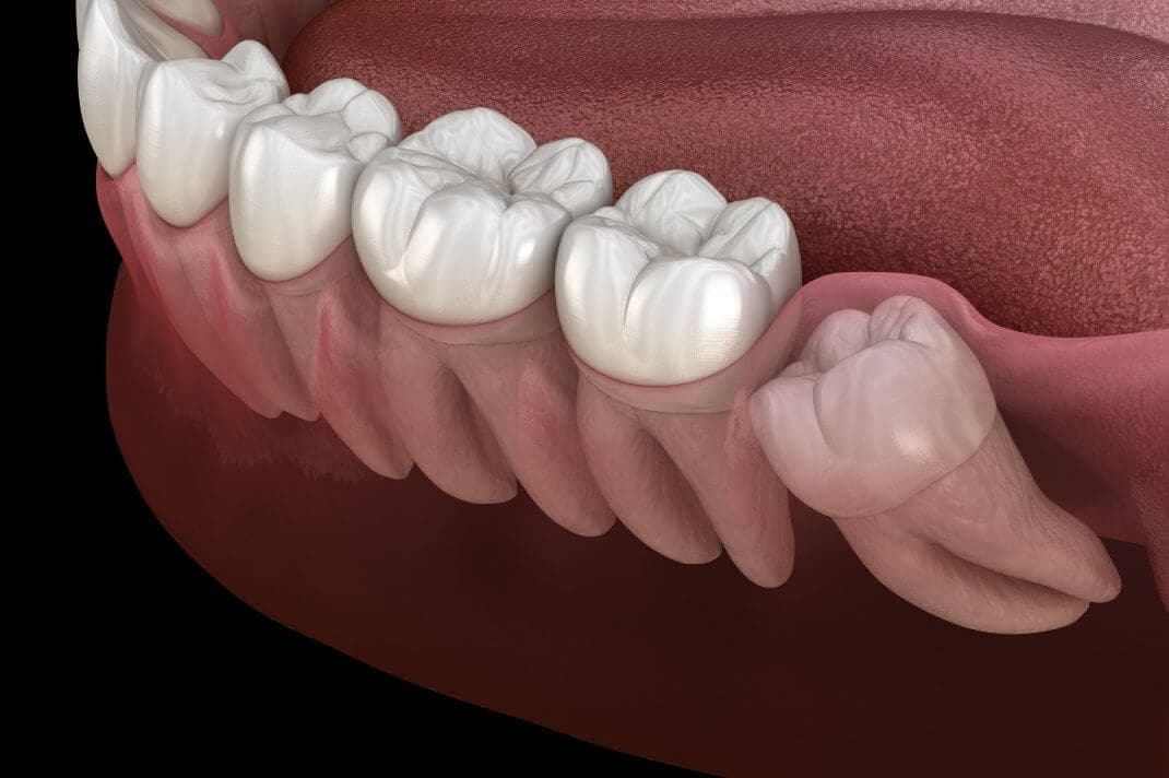 Estrazione Dente del Giudizio: Guida Completa su Dolore, Costi e Recupero