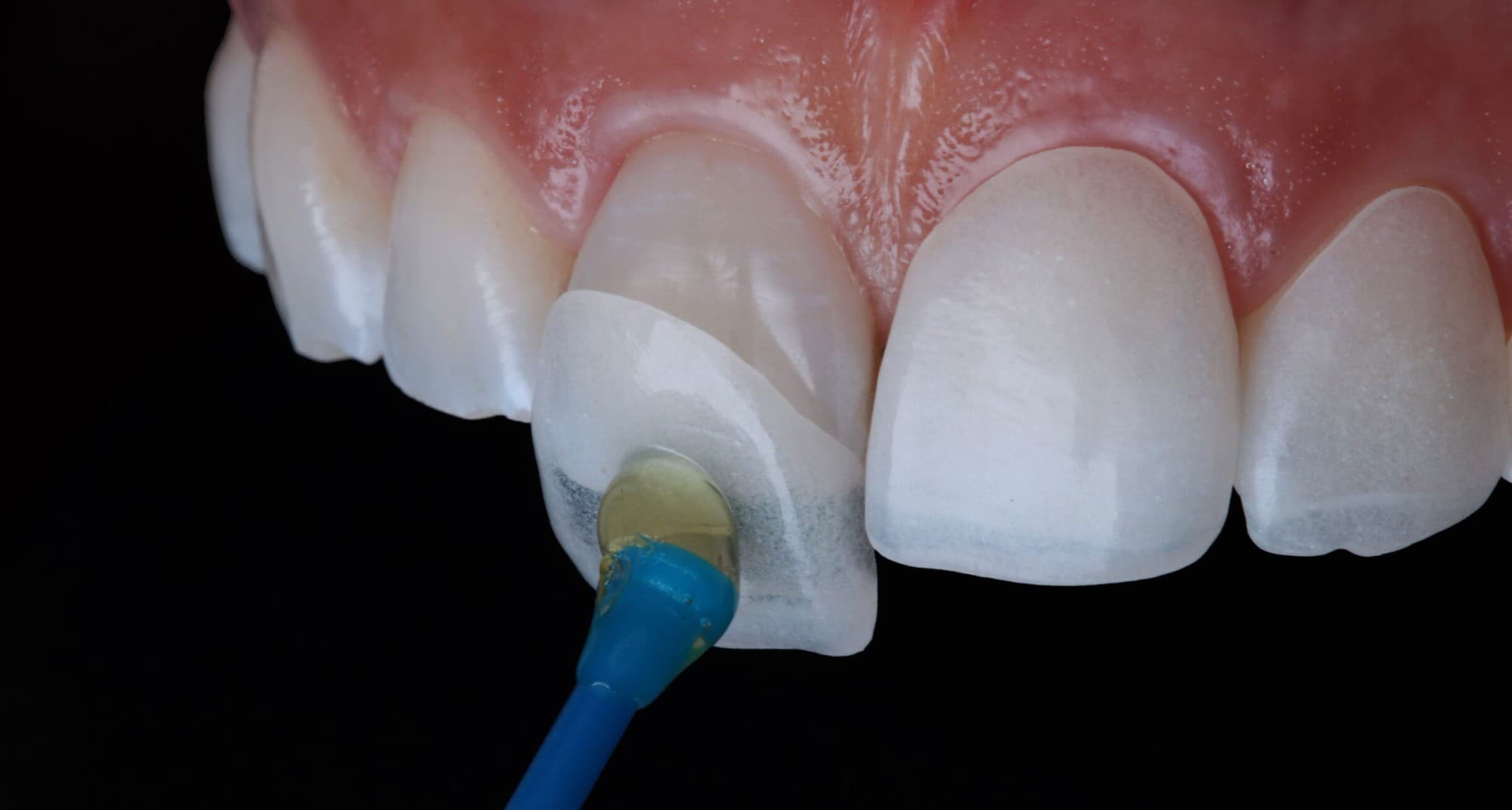 Faccette Dentali: Tipi, Costi e Guida Completa