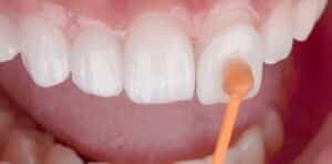 Faccette dentali: come avere denti perfetti in poche sedute