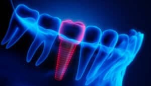 Parodontite sugli impianti: rischio di perimplantite