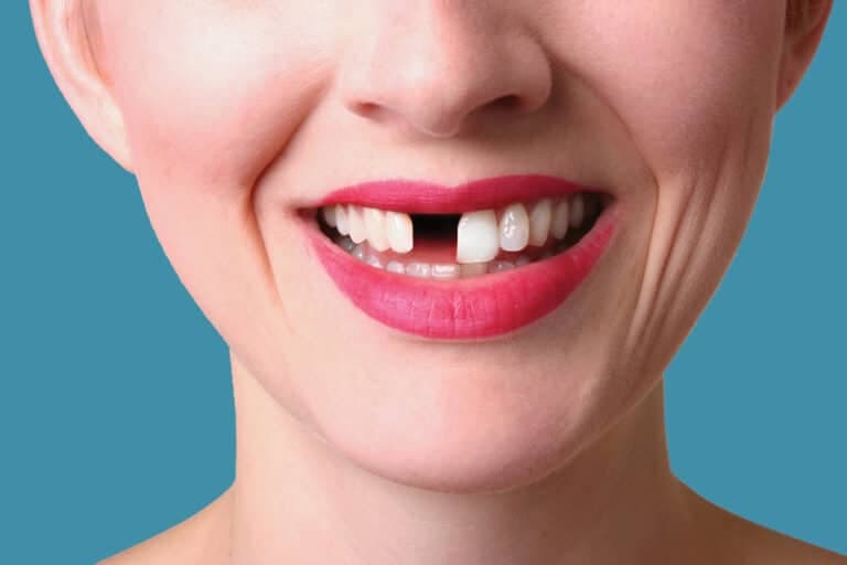 Perdere un dente: le conseguenze che non ti aspetti